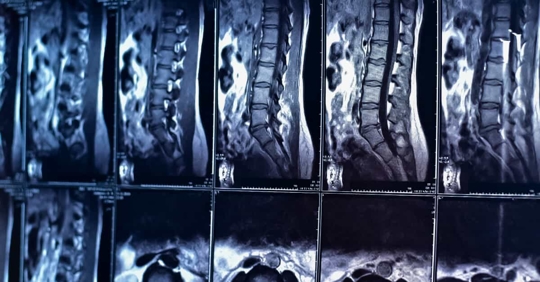 spinal cord injury